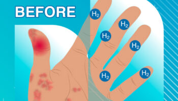 2.-Hydrogen-helps-reduce-skin-inflammation-quickly