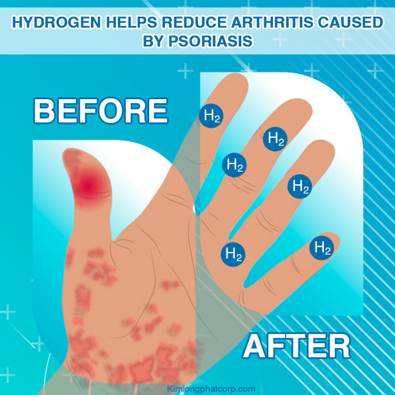 2. Hydrogen helps reduce skin inflammation quickly